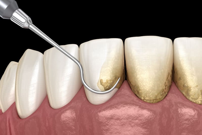 Scaling & Root Planing | Cambridge, Oh | Woodlawn Dental Center